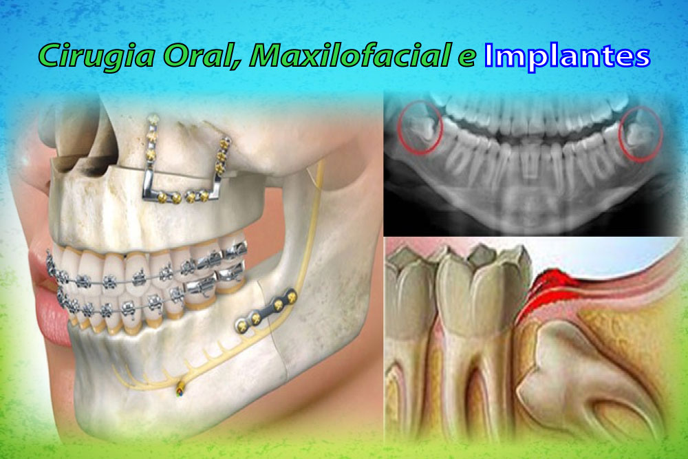 Cirugia Oral, Maxilofacial e Implantes