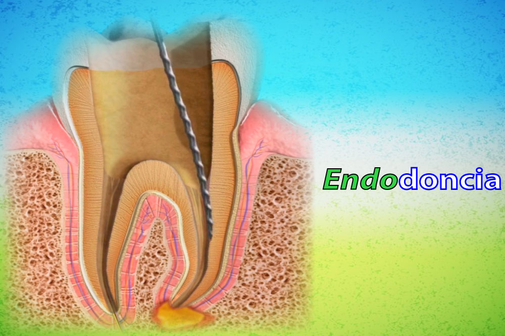 Endodoncia