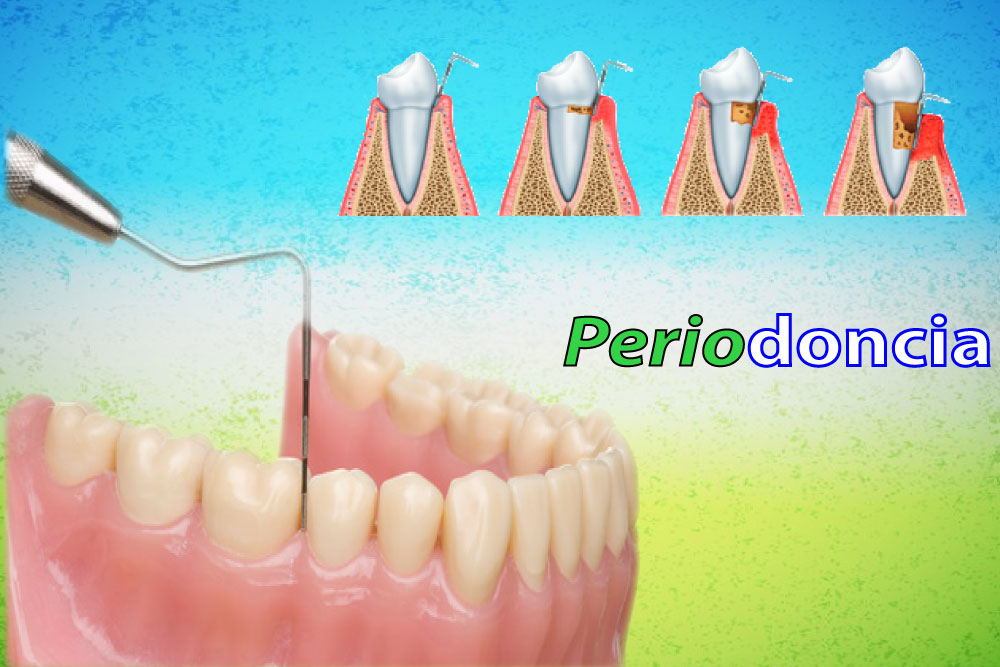 Periodoncia